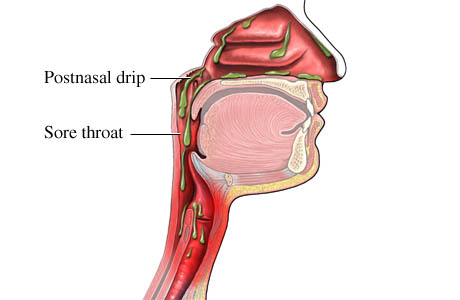 Diagram of post nasal drip.